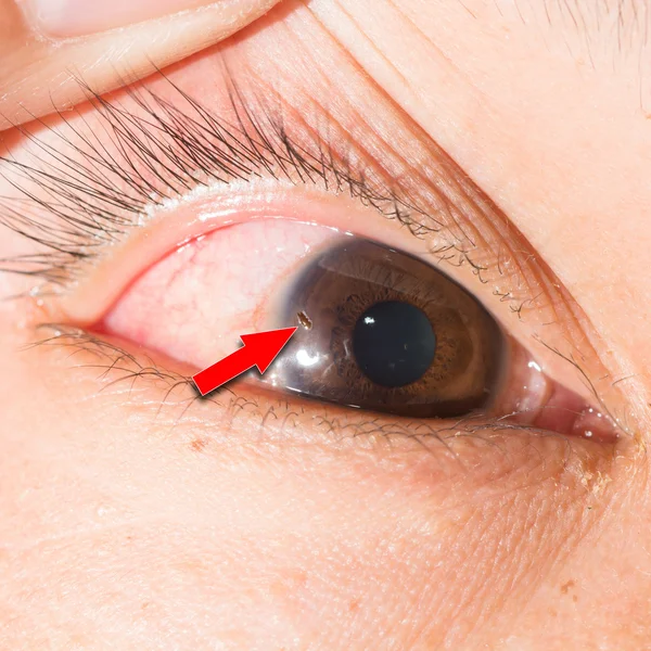Episcleritis at eye exam