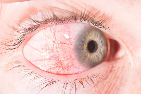 Episcleritis at eye exam