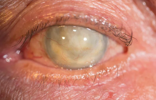 Phthisis bulbi at eye test