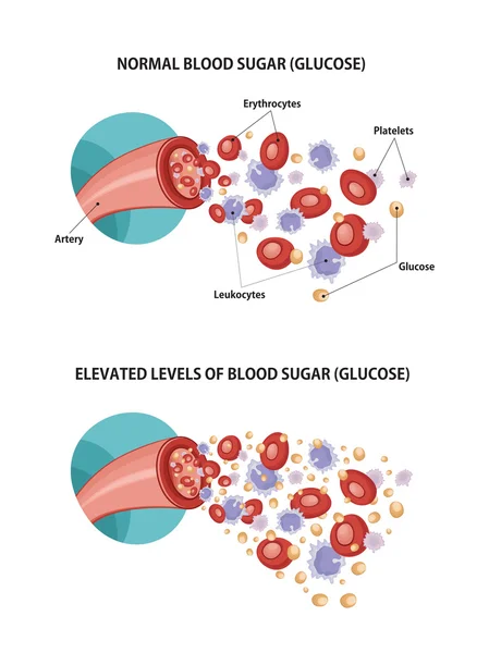 Artery and diabetes, medical diagram