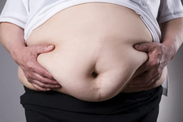 Obesity woman body, fat female belly with a scar from abdominal surgery close up