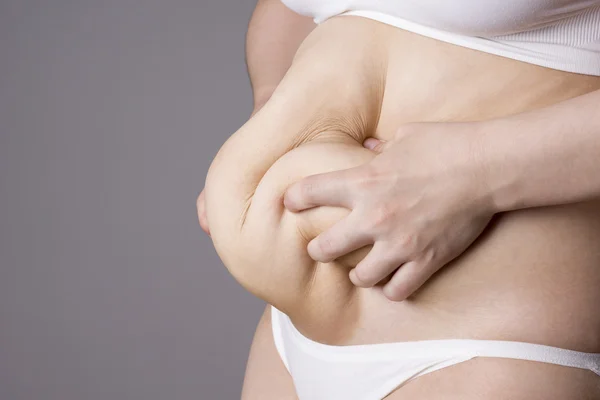 Obesity female body, fat woman belly close up