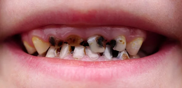 Caries on teeth of the child