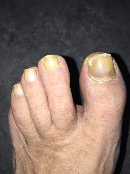 Toe nails with mucosis