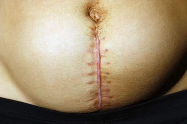 Seams after the operation of Caesarian section