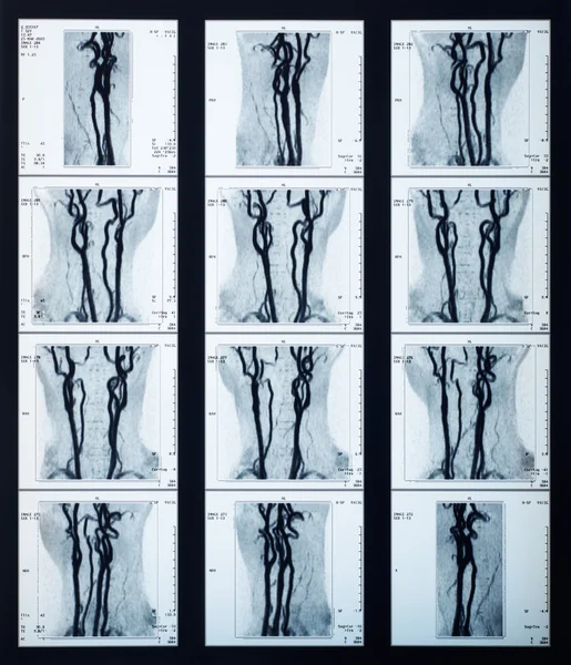 X-ray veins radiography
