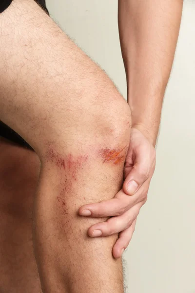 Close up view of nasty wounds on man\'s knee