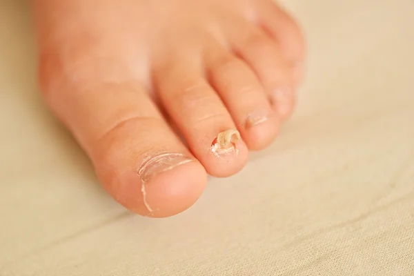 Nail fungus on a toenail