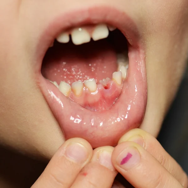 Girl after dental extraction