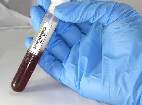 Ebola blood test tube in a medical laboratory