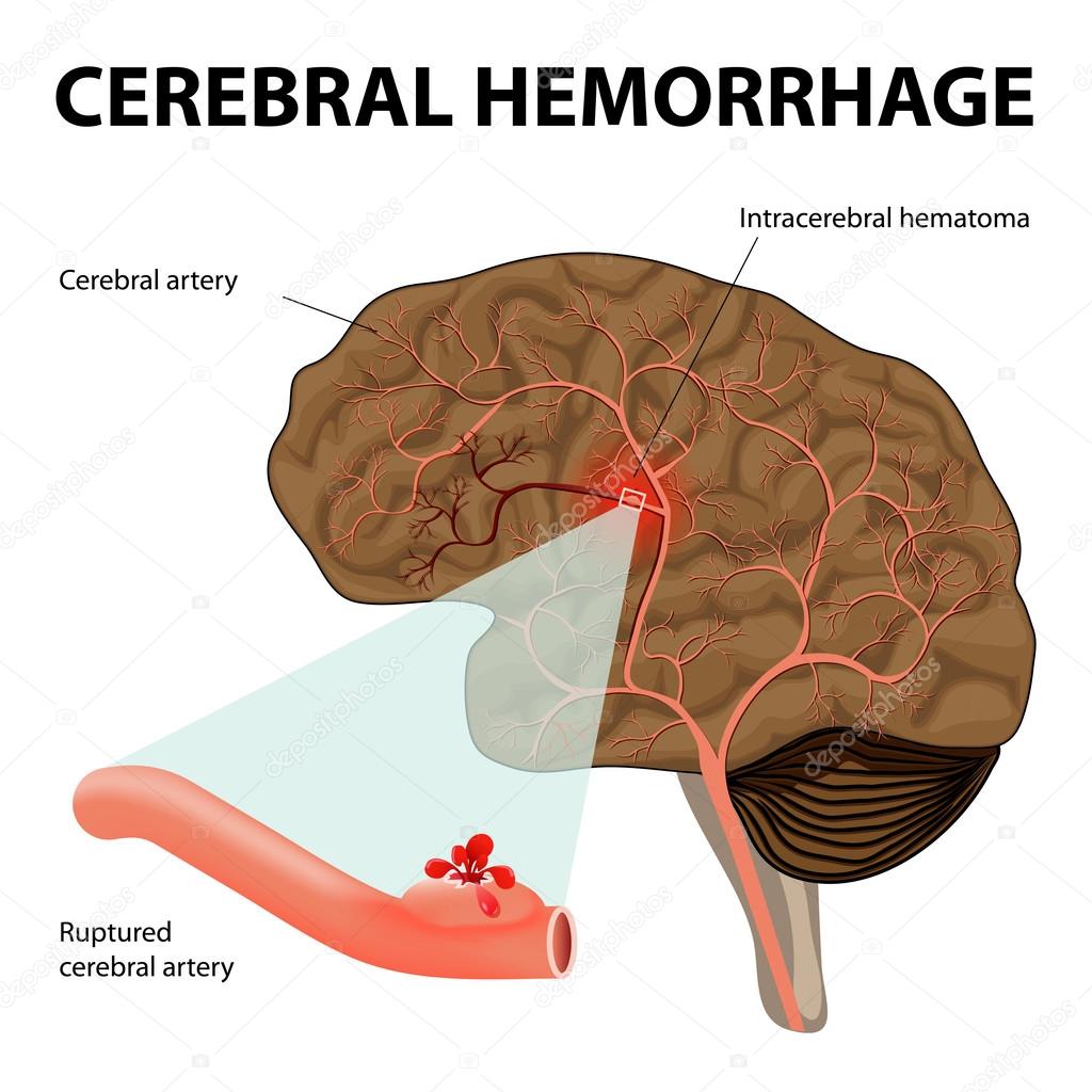 stroke protocol cta stroke rehab for young adults