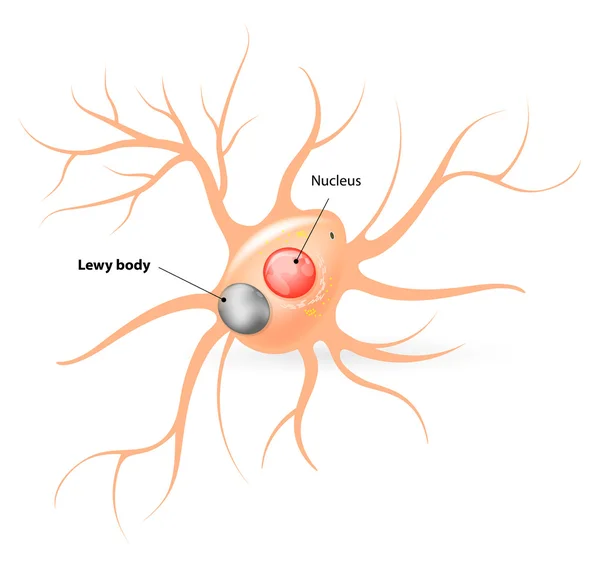 Lewy body. Parkinson\'s disease and Alzheimer\'s disease