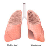 chronic obstructive pulmonary disease research paper