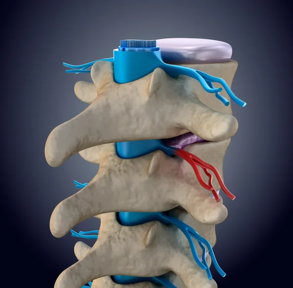 Spinal cord under pressure of bulging disc