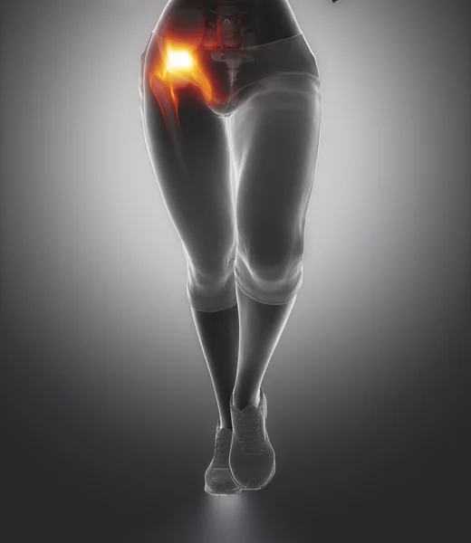 Hip injury concept