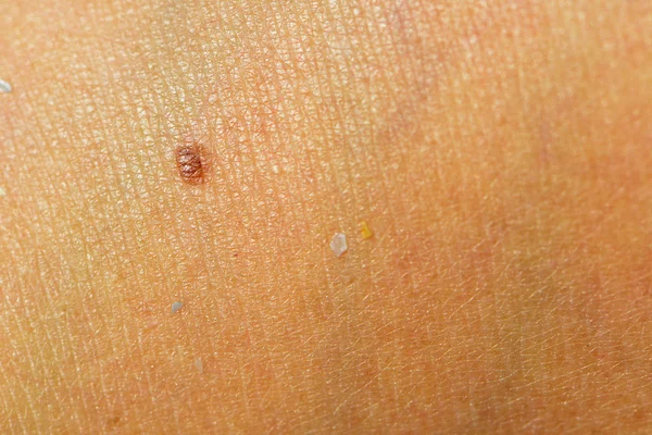 Beauty spot freckle fleck on tanned human skin detail