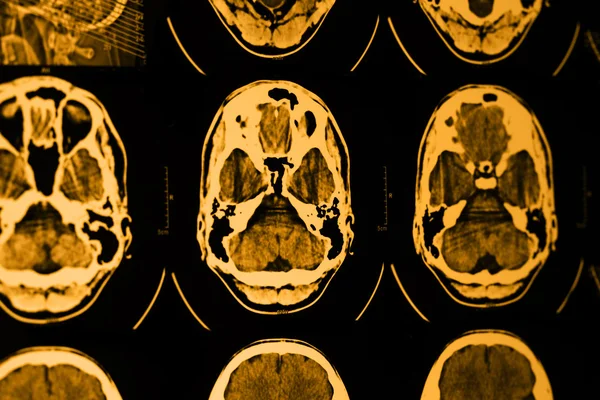 CT and MRI of skull