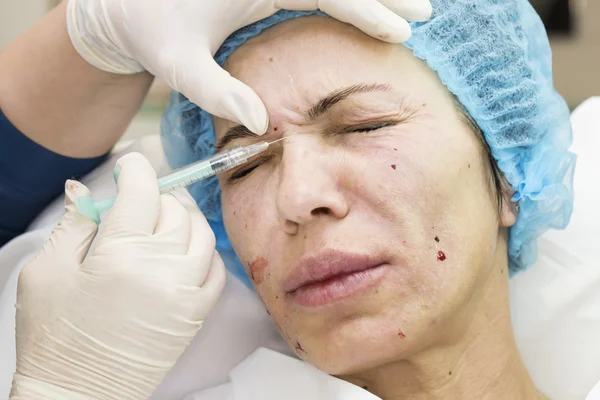 Cosmetic treatment with injection