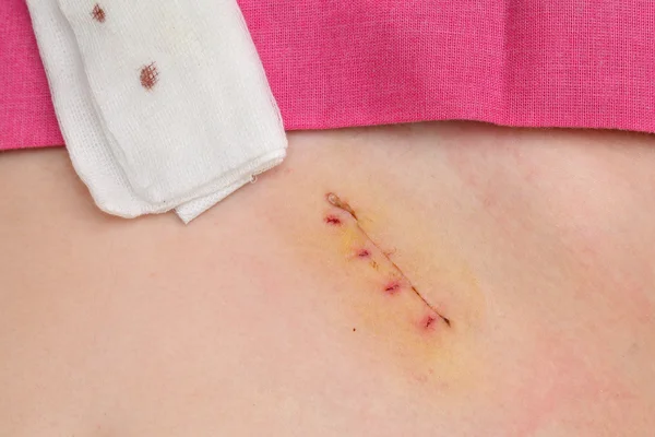 Medicine, appendectomy surgery scar