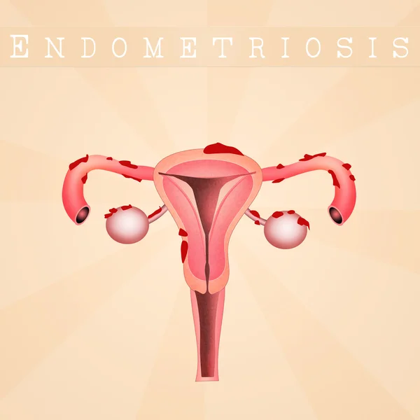 Endometriosis disease scheme