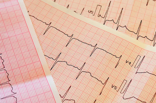 The results of the electrocardiogram of the heart.