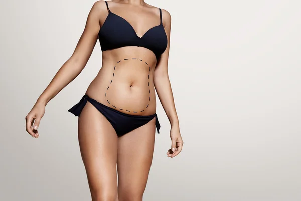 Female body with lines for liposuction