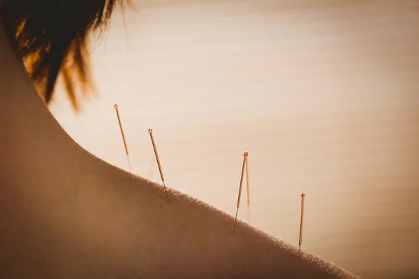 Woman getting acupuncture treatment