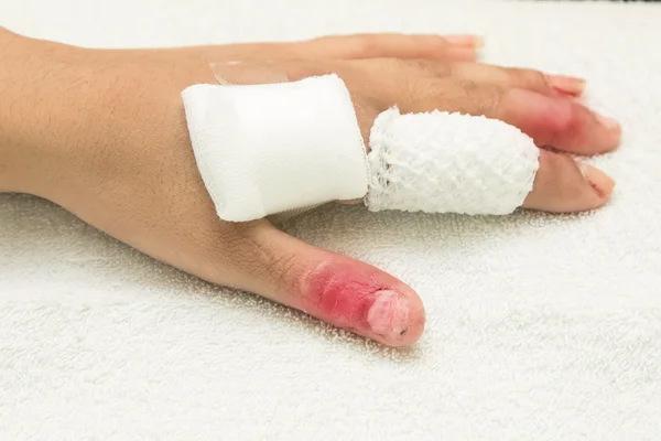 Injured finger wrapped in a gauze bandage after surgery
