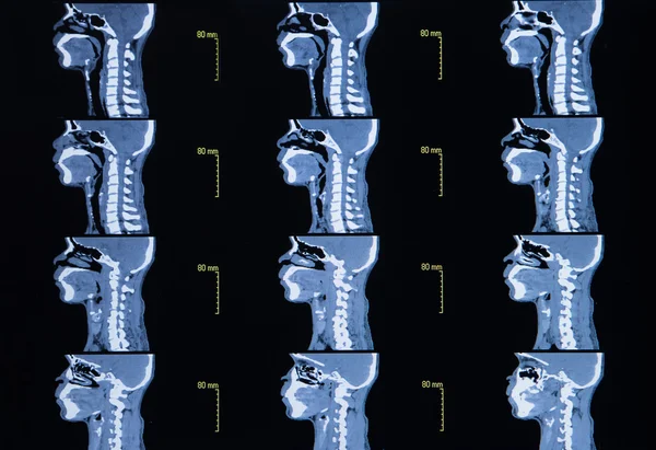 Series of images from a computerized tomography of neck (cervica