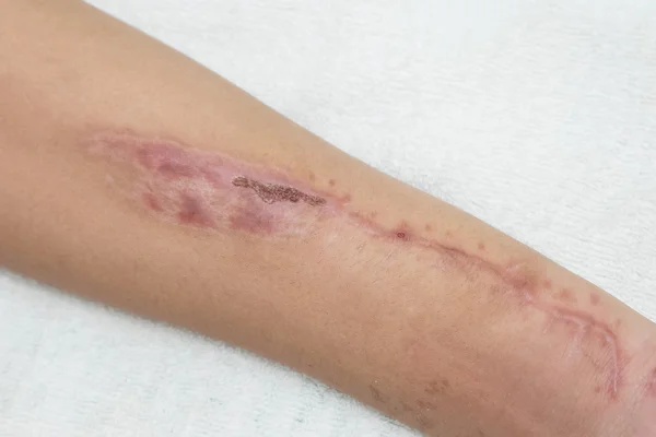 Old scar wound in the forearm
