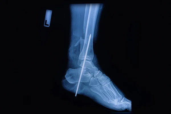 Fracture of the lower part of the fibula, sagital view X-ray