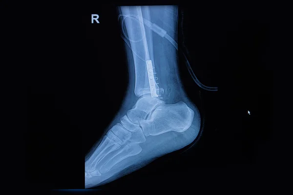 Fracture of the lower part of the fibula, sagital view X-ray