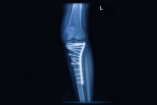 X-ray of fracture tibia(leg bone). tibia bone with internal fixe