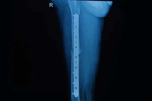 Human x-rays showing fracture of femur bone , post operated