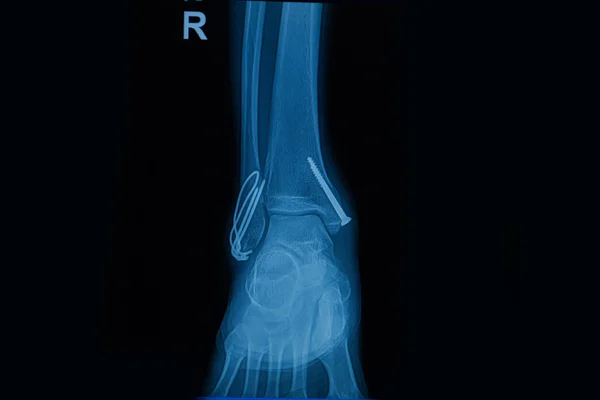 Collection of human x-rays showing fracture of right leg ( frac