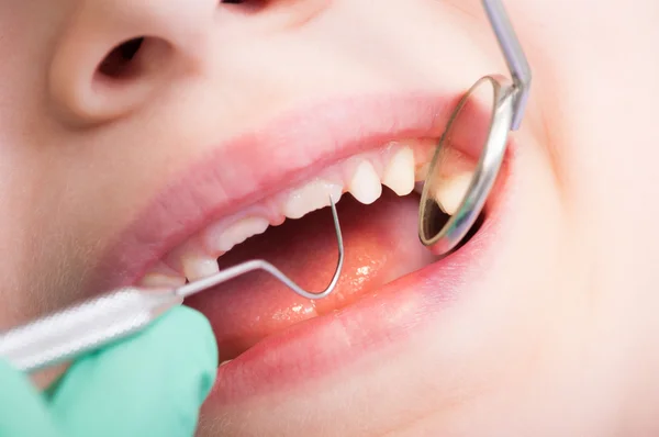 Closeup of kid mouth with mirror at dentist