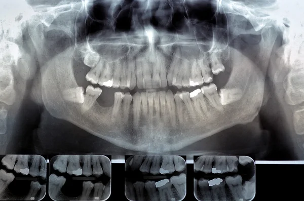 Dental radiography. Digital x-ray teeth scan of adult male