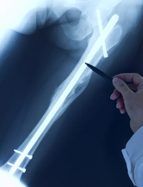Doctor orthopedist examine x-ray with broken leg after surgery