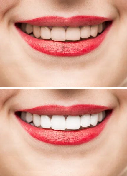 Teeth After and Before Whitening