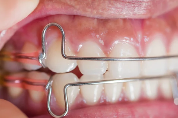 Teeth with braces.