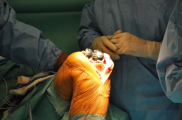 Prosthesis of the knee