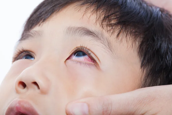 Closeup pinkeye (conjunctivitis) infection