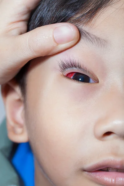 Closeup of Pinkeye (conjunctivitis) infection on a boy, doctor c