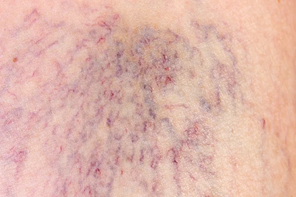 Close-up of dermis with varicose veins