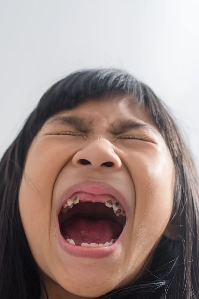 Open mouth showing caries teeth decay