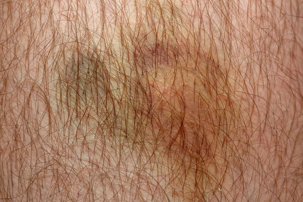 Nasty looking real bruise on man's skin, macro