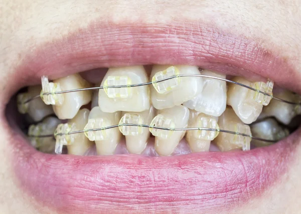 Close-up mouth of crooked teeth with braces.