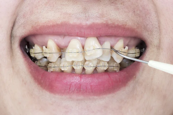 Close-up mouth of crooked teeth with braces and plaque remover