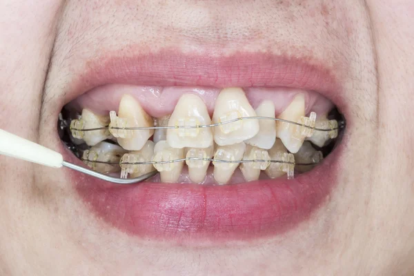 Close-up mouth of crooked teeth with braces and plaque remover