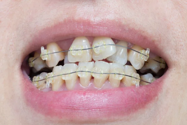 Close-up mouth of crooked teeth with braces